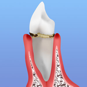歯周病初期