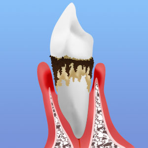 歯周病末期