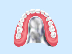 金属床義歯
