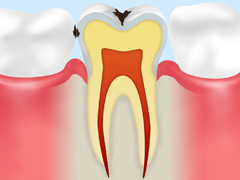 C1：エナメル質のむし歯