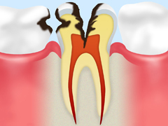 C3：神経にまで達したむし歯
